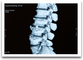 herniated disk injury after accident